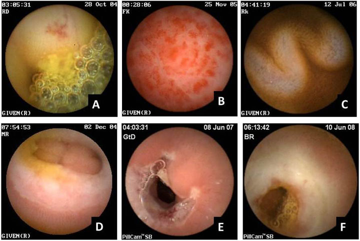 Pillcam : Swallow A Pill With A Miniature camera To Avoid Colonoscopy