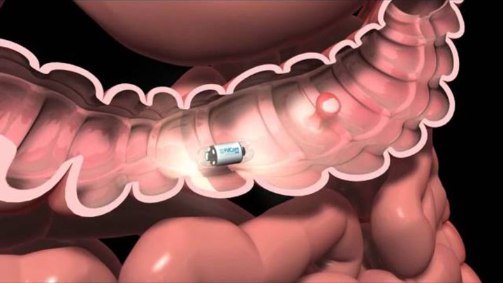Pillcam-Swallow A Pill With A Miniature camera To Avoid Colonoscopy-3