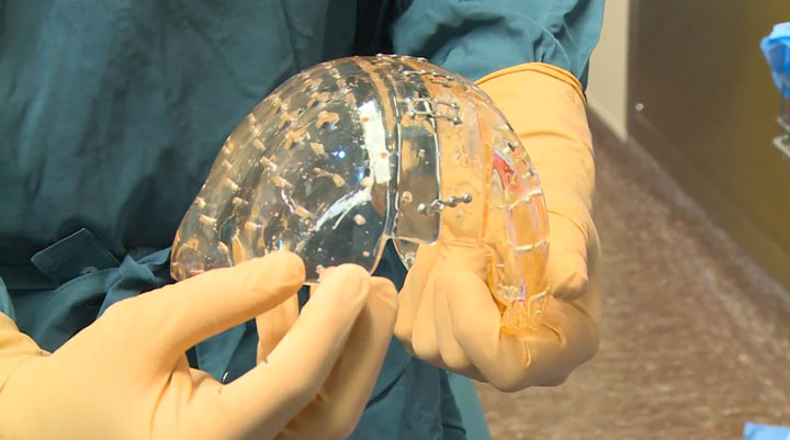 Surgeons Implant An Entirely 3D Printed Skull -