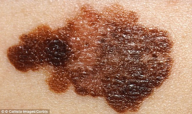 Diagnose Skin Cancer using Mobile