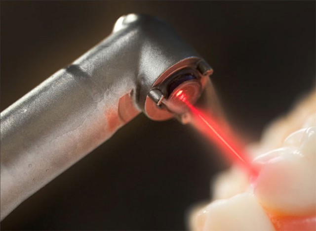 Scientists Discover A Laser Based Regenerating Treatment For Teeth-3