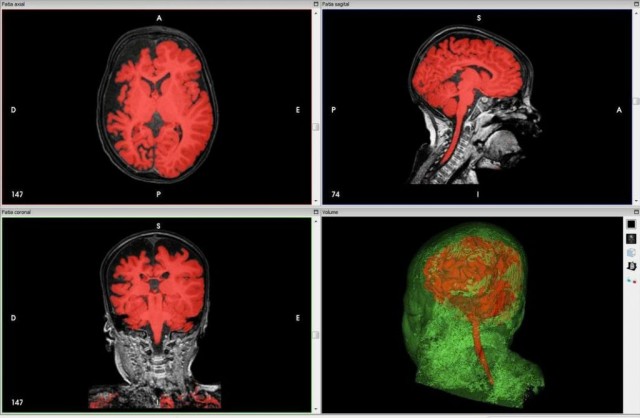 3D Printing Helps Neurosurgeons Perform Life Saving Surgery-1