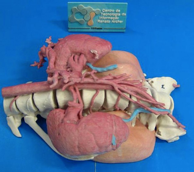 3D Printing Helps Neurosurgeons Perform Life Saving Surgery-3