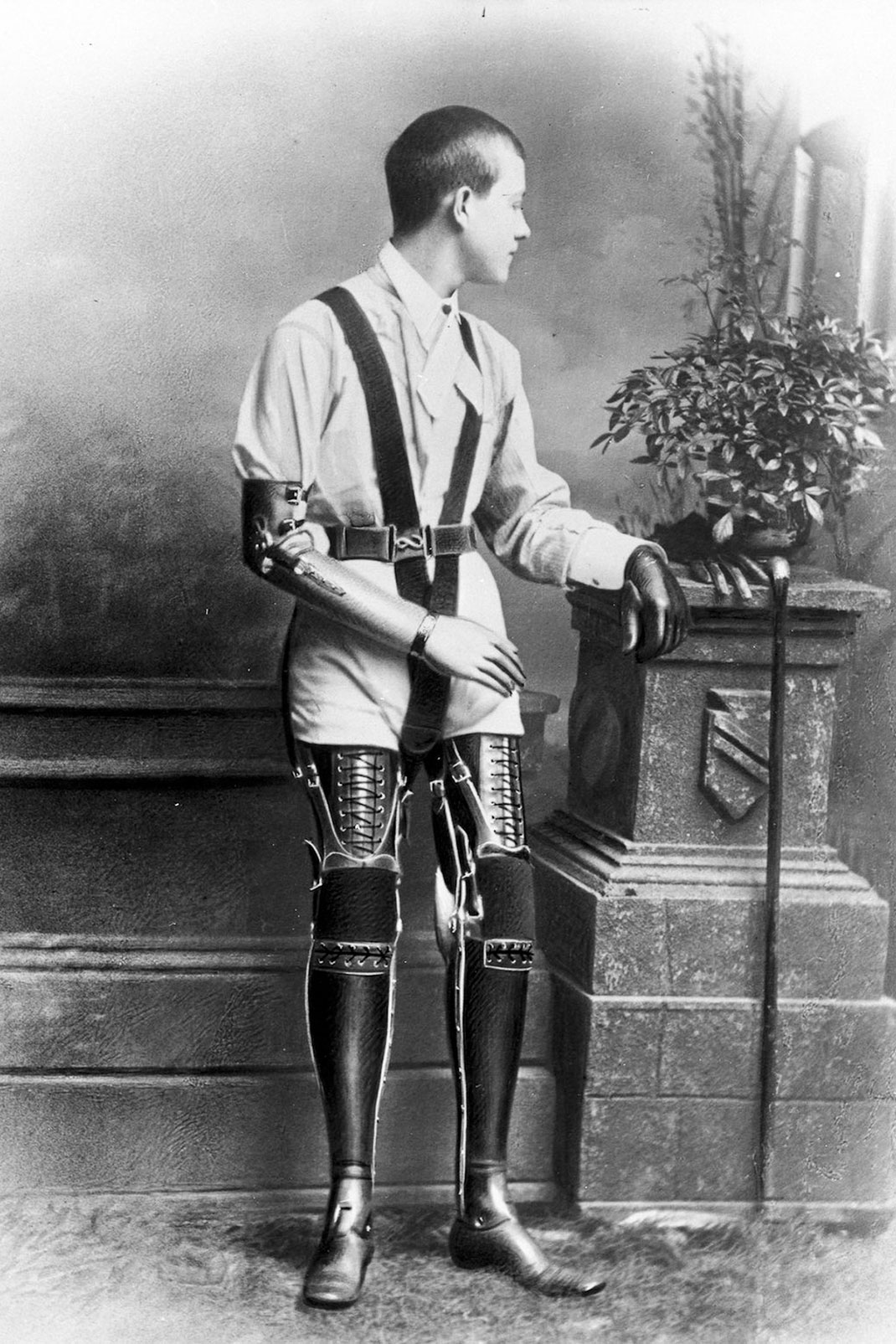 These Ingenious prostheses From 19th century helped 15,000 People Regain Mobility-6