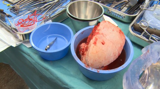 Surgeons Implant An Entirely 3D Printed Skull -2