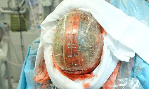 Surgeons Implant An Entirely 3D Printed Skull -5