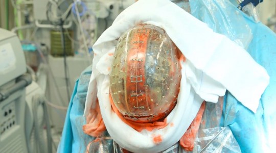 Surgeons Implant An Entirely 3D Printed Skull -6