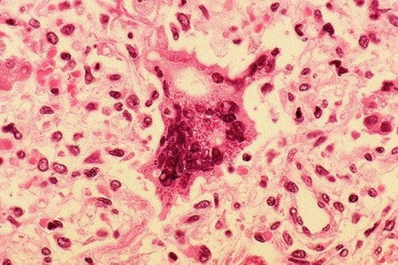Modified Measles Virus Injection Cures A Woman Suffering From Cancer-1