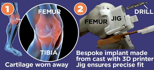 Knee replacement by Conformis