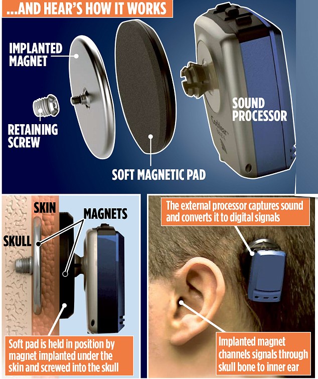 magnetic implant