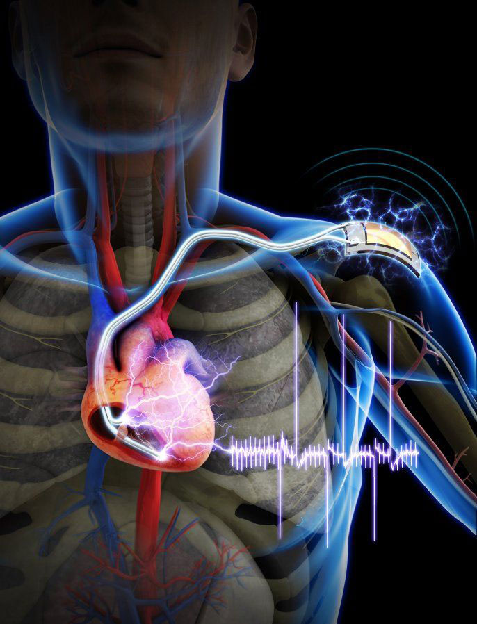 Soon Movements Of Muscles Will Power Heart Pacemakers-