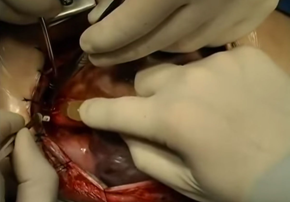 Stunning Video Showing step by step Heart Transplantation Surgery