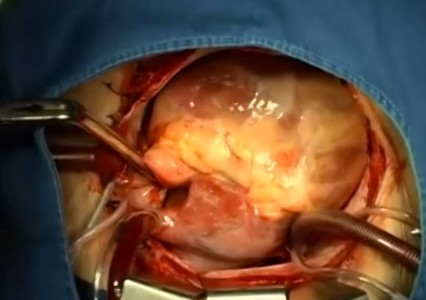 Stunning Video Showing step by step Heart Transplantation Procedure-1