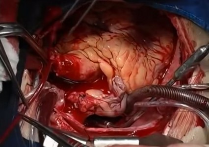 Stunning Video Showing step by step Heart Transplantation Procedure-2