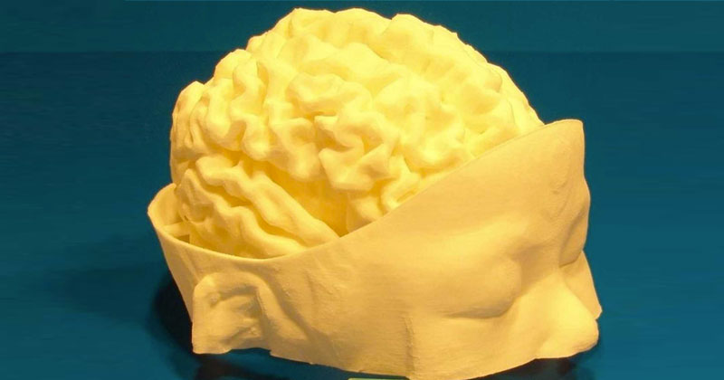 3D Printing Helps Neurosurgeons Perform Life Saving Surgery