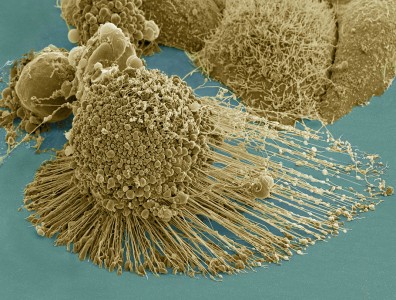 Cancer cells whe viewed from the electron microscope